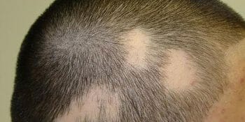 Tricología: Alopecia Androgenética y otras alopecias