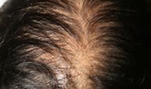 Alopecia Fernandez Crehuet