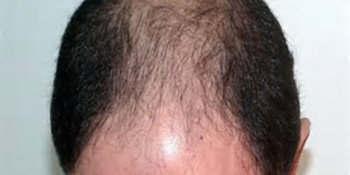 Clínica Alopecia Cordoba