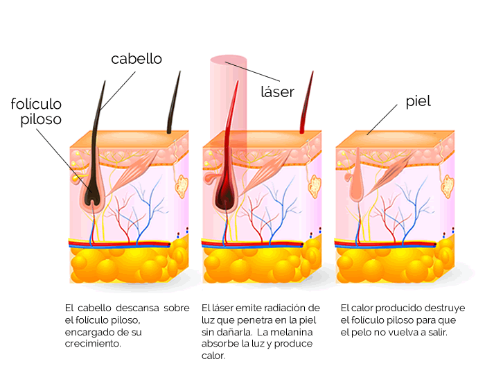 Depilación definitiva laser Alejandrita - Dermatólogos