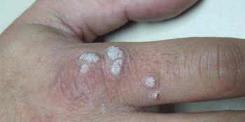Infecciones cutáneas: moluscos contagiosos, verrugas, micosis