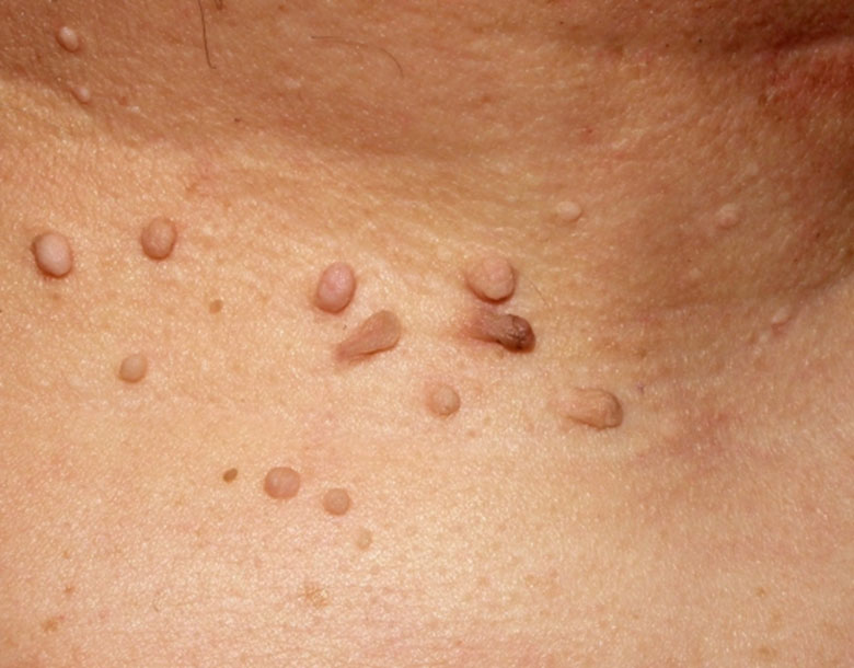 Cirugía de lesiones benignas y malignas Dermatólogos FernándezCrehuet