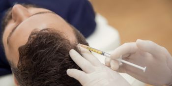 Micro infiltraciones de Dutasterida: Tratamiento para la alopecia