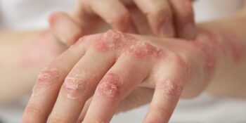 Psoriasis: por qué aparecen esas placas en la piel y cuándo acudir al dermatólogo